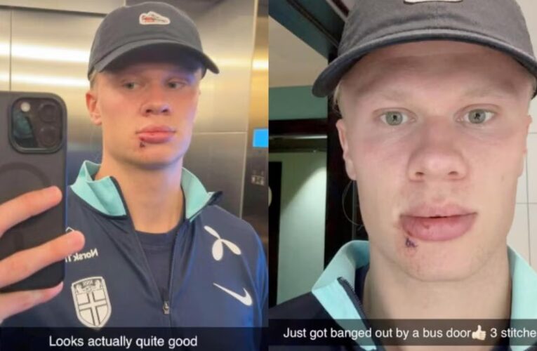 Haaland sufre accidente en autobus y comparte su herida con tres puntos de sutura